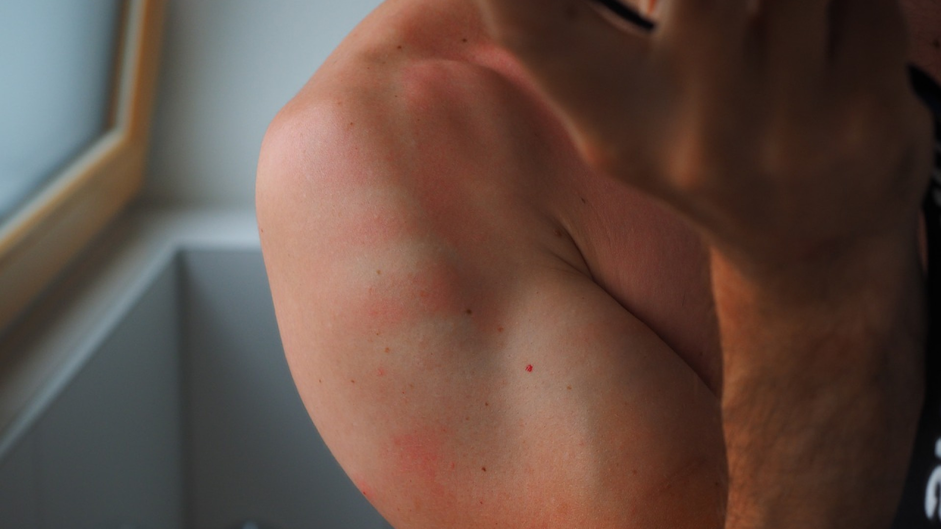 Quel traitement naturel de la dermatite atopique ?