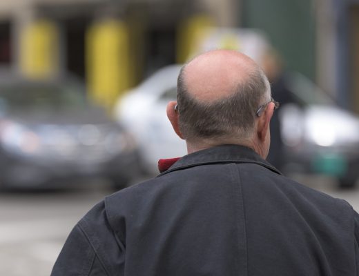 La greffe de cheveux : un procédé efficace