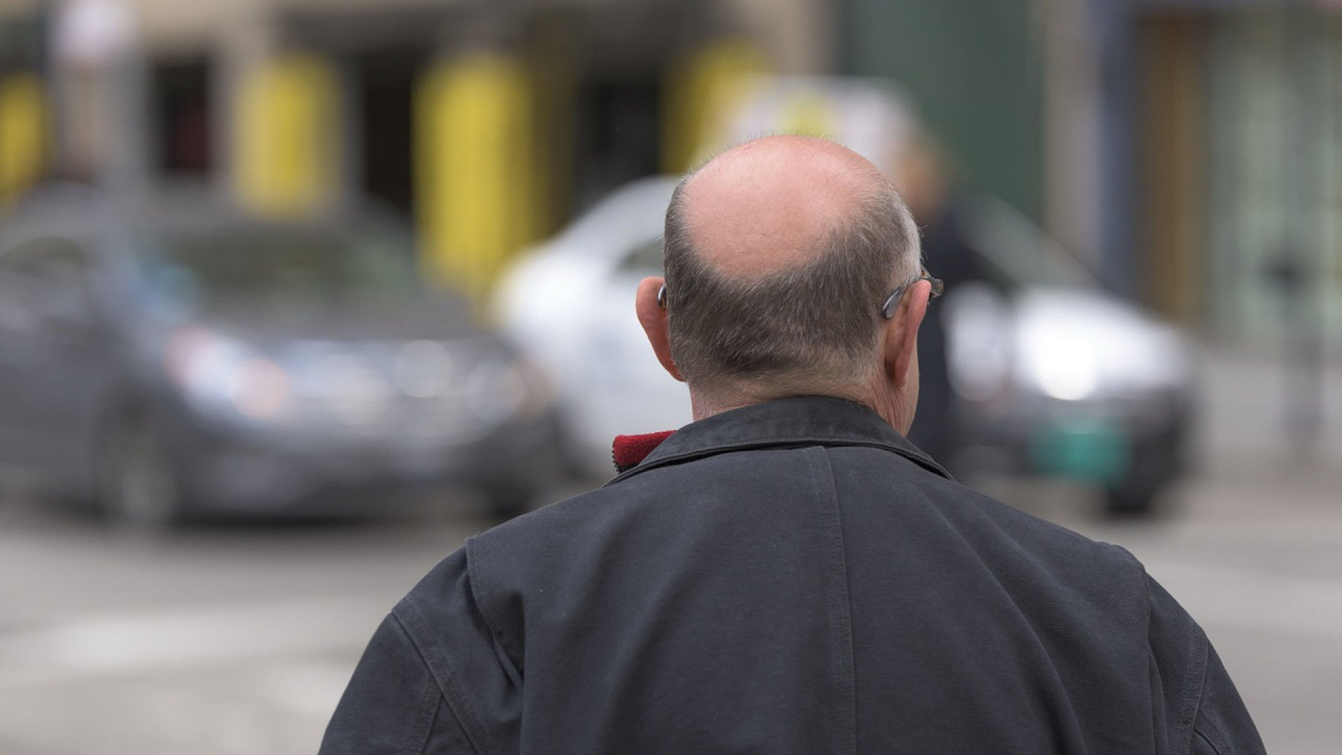 La greffe de cheveux : un procédé efficace